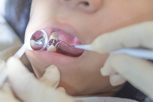 How Dental Sealants Prevent Cavities In Kids